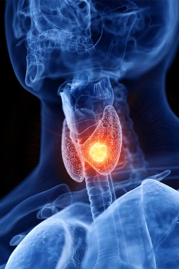 Thyroid-Imbalance-Treatment A 3D illustration of an x-ray of a human neck, highlighting the thyroid. Get help with thyroid imbalance from Delara Tavakoli, M.D. of Tavicare in Chevy Chase.